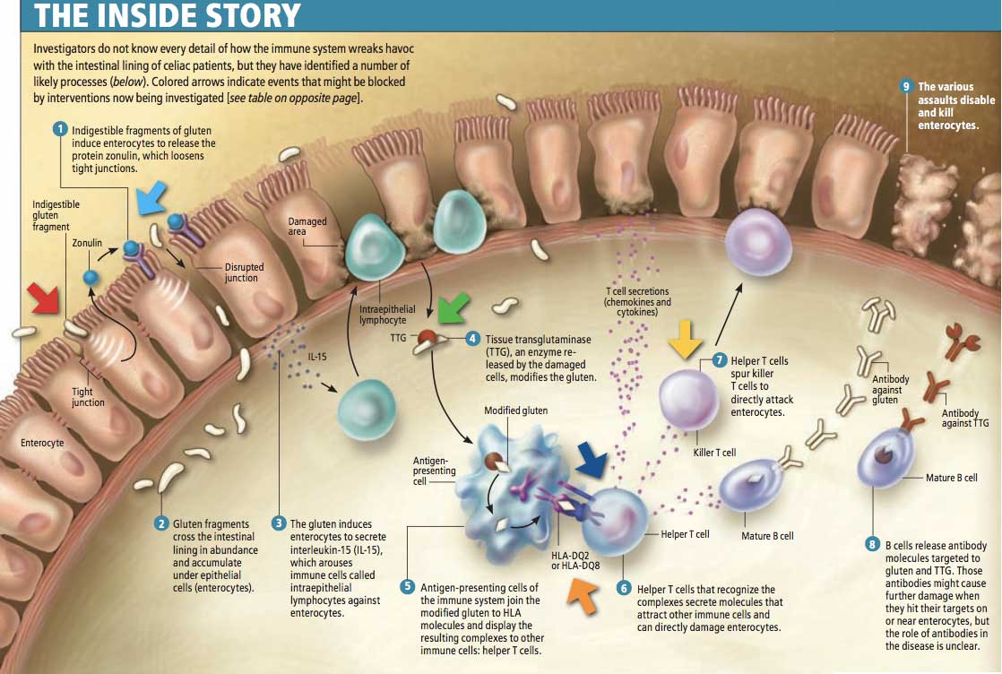 Глютен, кишечная проницаемость, целиакия и аутоиммунные заболевания